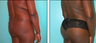 Brazilian Butt Lift Before & After