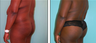 Brazilian Butt Lift Before & After