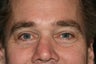 Tear Trough Rejuvenation male