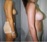 27 years female underwent Breast lift along with augmentation for sagging and asymmetry