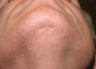 DIFF ANGLES - Face to scalp hair transplant using Neograft technique