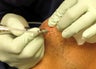 DIFF ANGLES - Face to scalp hair transplant using Neograft technique
