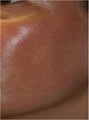 Fraxel - Melasma