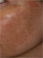 Fraxel - Melasma