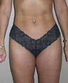 Liposuction