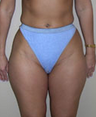 Liposuction