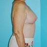 Right DIEP Flap Breast Reconstruction