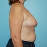 Right DIEP Flap Breast Reconstruction