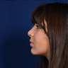 Chin Augmentation