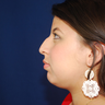 Chin Augmentation