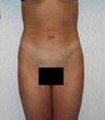 Liposuction (lateral thighs and abdomen)