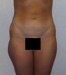 Liposuction (lateral thighs and abdomen)