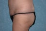 Circumferential Body Lift