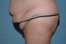 Circumferential Body Lift
