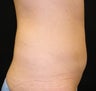 CoolSculpting
