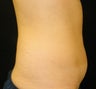 CoolSculpting