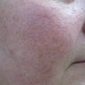 64 year old male with facial veins / telangiectasia