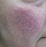 64 year old male with facial veins / telangiectasia