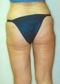 Female patient who underwent a thigh lift