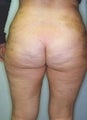 Female patient who underwent a thigh lift