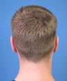 Cosmetic ear reshaping in this younger male patient seeking otoplasty correction