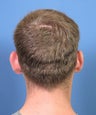 Cosmetic ear reshaping in this younger male patient seeking otoplasty correction