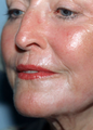 Laser Resurfacing