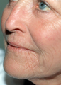 Laser Resurfacing