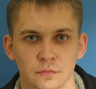 Otoplasty