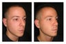 Rhinoplasty