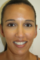 Ear reshaping was accomplished on the left ear to match her right ear. This is called a unilateral Otoplasty.