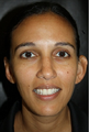 Ear reshaping was accomplished on the left ear to match her right ear. This is called a unilateral Otoplasty.