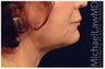 Facial Rejuvenation