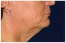 Facial Rejuvenation