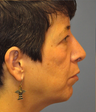 Rhinoplasty and chin augmentation