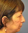 Rhinoplasty and chin augmentation