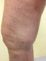 55 year old man with varicose veins treated by EVLT.