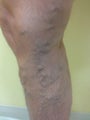 55 year old man with varicose veins treated by EVLT.