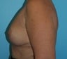 Bilateral Implant Removal with Breast Lift