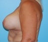 Bilateral Implant Removal with Breast Lift