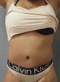 Revision of Abdomen from a "Cosmetic Surgeon"