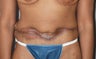 Revision of Abdomen from a "Cosmetic Surgeon"