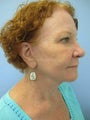 Face skin rejuvenation, woman, spot removal