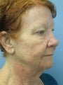 Face skin rejuvenation, woman, spot removal