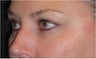 Restylane