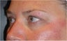 Restylane