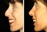 42 year-old female with a nose she feels is “too big” in proportion to the rest of her facial features.
