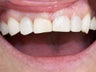 Bonding to Fix Chipped Front Tooth Before & After Photo