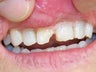 Bonding to Fix Chipped Front Tooth Before & After Photo