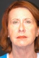64-year-old lady after endoscopic brow, quad bleph and lower face & necklift